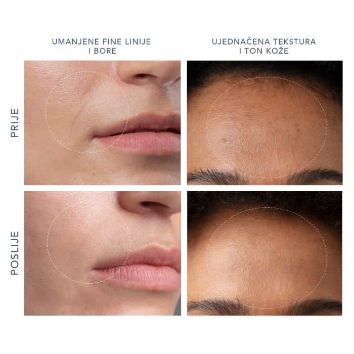 FOREO KIWI Derma, Uređaj za dijamantnu mikrodermoabraziju i vakuum pora prednosti korištenja