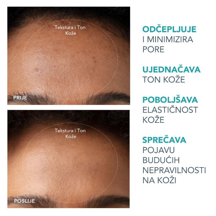 FOREO KIWI Uređaj za vakuumsko uklanjanje mitesera s LED svjetlom prije i poslije rezultati