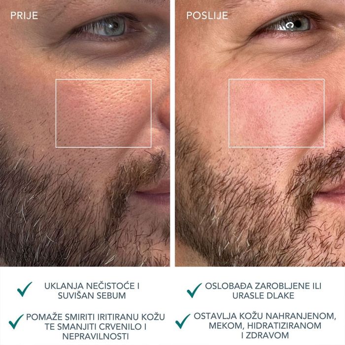 FOREO LUNA 4 Men Pametni Uređaj za Čišćenje Lica za Muškarce prije i poslije